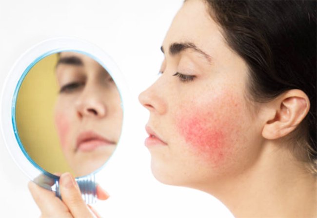 Basic Skincare Tips and Remedies for Acne and Rosacea